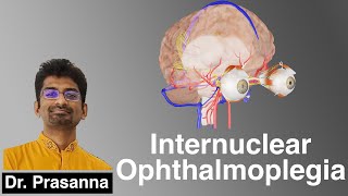 Internuclear Ophthalmoplegia [upl. by Lunette]