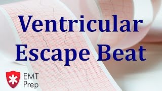 Ventricular Escape Beat ECG  EMTprepcom [upl. by Katzir530]