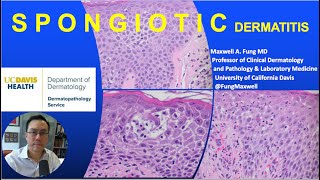 DERMATOPATHOLOGY Spongiotic Dermatitis [upl. by Odlanier]