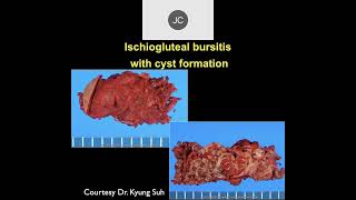 MRI of the Hip Part 10 – Hip Inflammation [upl. by Ellennej843]