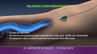 Animation of Ablación Laser Endovenosa [upl. by Ion278]