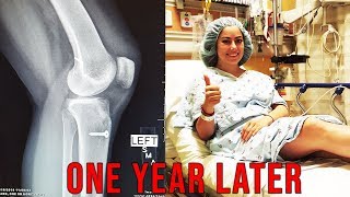 ONE YEAR OF ACL SURGERY RECOVERY [upl. by Salakcin521]