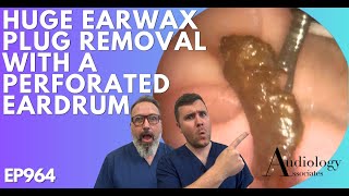 HUGE EAR WAX PLUG REMOVAL WITH A PERFORATED EARDRUM  EP964 [upl. by Jessalin341]