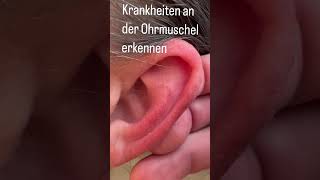 Krankheiten an der Ohrmuschel erkennen [upl. by Thanasi113]