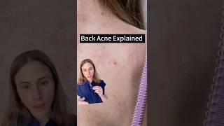 Uncovering The Truth About Back Acne [upl. by O'Carroll599]