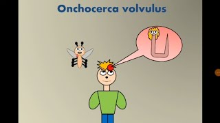 Onchocerca volvulus River blindness عمى الأنهار [upl. by Kcirddahc806]