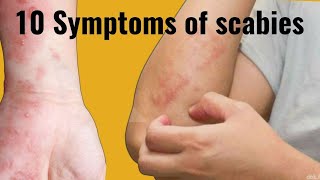 Symptoms of scabies [upl. by Suirauqed]