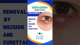 Chalazion Treatment Incision and Curettage  CLIO Eye Care [upl. by Norrabal176]