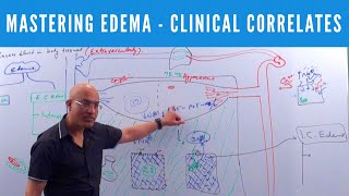 Mastering Edema  Types Causes Symptoms amp Treatment 👨‍⚕️ [upl. by Jayne]