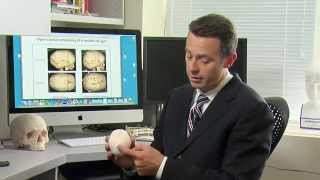 Craniosynostosis Treatment Options for Sagittal Synostosis  Part 5 of 6 [upl. by Bendicty]