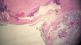 Polymorphous Low Grade Adenosarcoma of the Minor Salivary Gland [upl. by Nnylirehs270]