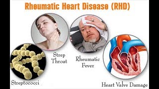 rheumatic heart disease symptoms [upl. by Leiram]