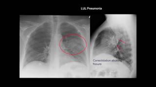 Chest Xray Cases 1 [upl. by Naahsar]