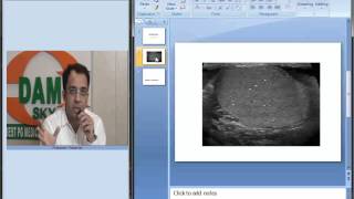 Radiology Spotters Part 18 Testicular microlithiasis [upl. by Nahij]