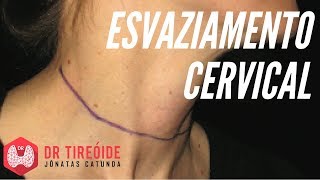 Esvaziamento Cervical  Dr Jônatas Catunda [upl. by Okechuku]