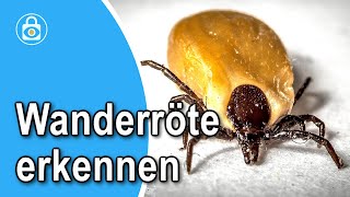 Wanderröte erkennen Ursachen Symptome und Behandlung der Zeckenbiss Rötung [upl. by Keemahs640]