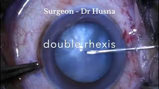 Double rhexis in intumescent cataract [upl. by Gipps387]