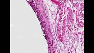 Histopathology Lung Squamous cell carcinoma [upl. by Cull]