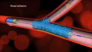 Main Branch Bifurcation Stent quotPROVISIONALquot by Advanced Bifurcation Systems [upl. by Urbannal]