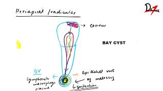 Radicular cyst  PATHOGENESIS CF RF amp TREATMENT [upl. by Rehpotsirh]