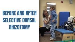 Before and After Selective Dorsal Rhizotomy for cerebral palsy [upl. by Narut850]