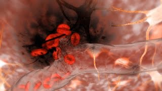 Hemorrhagic Stroke Brain Hemorrhage [upl. by Wordoow24]