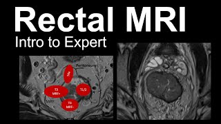 Rectal MRI Intro to Expert Rectal Cancer Staging [upl. by Asin589]