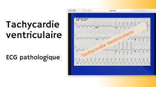 Tachycardie ventriculaire  ECG pathologique  arythmie [upl. by Hamilton634]