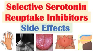 SSRI Antidepressant Side Effects amp Why They Occur  Fluoxetine Paroxetine Sertraline Citalopram [upl. by Neehsas]