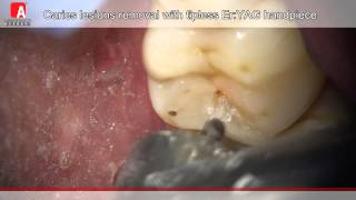 Caries Removal amp Cavity Preperation with Fotona Lightwalker ErYAG Laser [upl. by Pontias455]