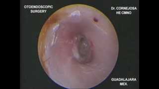 EXPLORACIÓN ENDOSCÓPICA DE MEMBRANA TIMPÁNICA PERFORADA Dr Cornejosa [upl. by Arded]