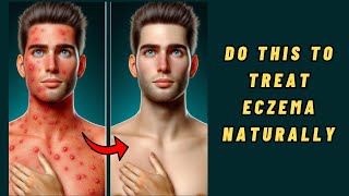 How to Get Rid of Eczema  How To Treat Eczema Naturally [upl. by Arries624]