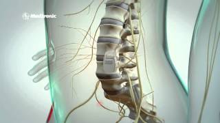 Rückenmarkstimulation bei chronischen Schmerzen Spinal Cord Stimulation SCS [upl. by Elboa699]