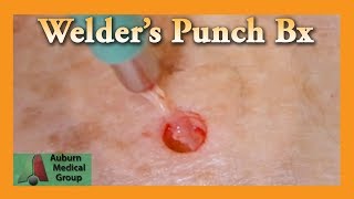 Welders Punch Biopsy  Auburn Medical Group [upl. by Dranreb]