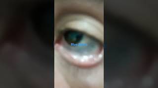 Unveiling the Mystery of Blue Sclera [upl. by Aneliram]