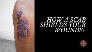 How a Scab Shields Your Wounds [upl. by Denyse]