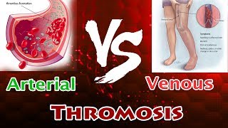 Arterial Thrombosis Vs Venous Thrombosis  Clear Comparison [upl. by Ashti768]