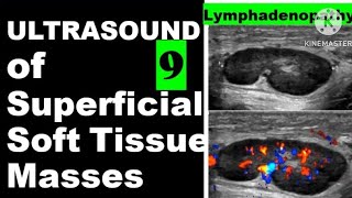 Lymphadenopathy [upl. by Naellij]