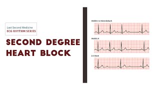 Second degree AV Block  Heart Blocks  ECG Rhythm Series [upl. by Reed]