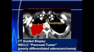 Pancoast Tumor and Superior Sulcus Lung Mass [upl. by Kelson]