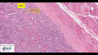 Thyroid follicular adenoma microscopy  Talking slide [upl. by Kleeman104]