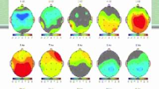 Becky Bingham Brain maps Part 2 The QEEG report [upl. by Desirea315]