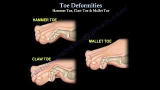 Toe Deformities Hammer Claw amp Mallet Toes  Everything You Need To Know  Dr Nabil Ebraheim [upl. by Newob]