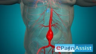 Open Abdominal Aortic Aneurysm and Endovascular Aneurysm Repair Surgery [upl. by Carvey]