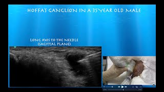 Ultrasound Guided Aspiration and Injection of a Hoffas Fat Pad Ganglion [upl. by Anoit156]