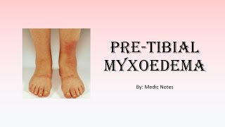 Pathophysiology of pretibial myxoedema [upl. by Llegna]