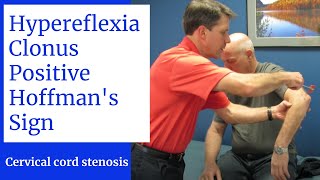 Hyperreflexia Clonus Positive Hoffmans Sign Central Cervical Spine Stenosis [upl. by Currie]