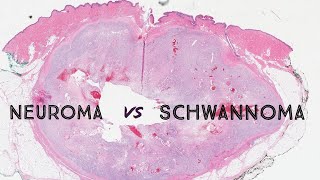 Neuroma vs Schwannoma palisaded encapsulated neuroma nerve sheath tumor dermpath dermatology [upl. by Cristin]