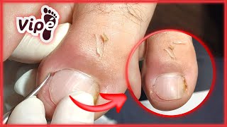 PODOLOGIA EM UNHA ENCRAVADA OVERGROWN INFECTED INGROWN TOENAIL REMOVAL [upl. by Yesteb]