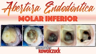 Abertura Endodôntica  Molar Inferior [upl. by Hintze]